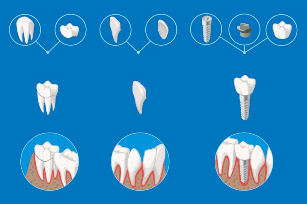 أنواع زراعة الأسنان وافضلها
