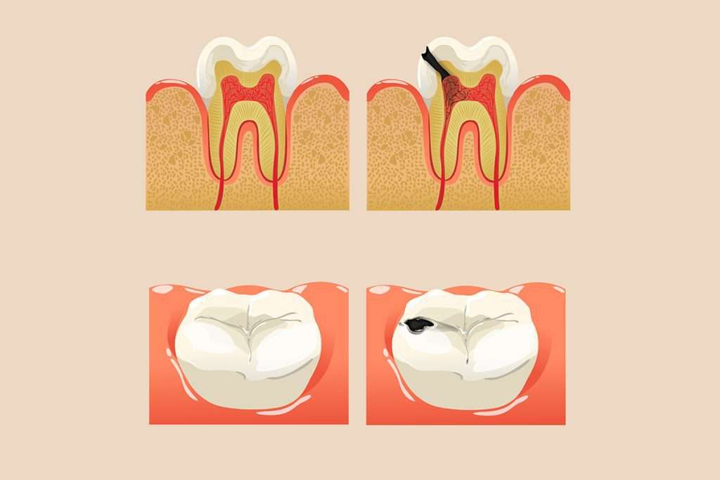 دكتور علاج عصب اسنان