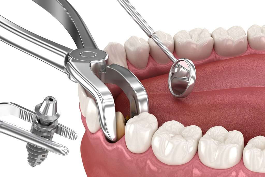 الفرق بين زراعة الأسنان الفورية والتقليدية