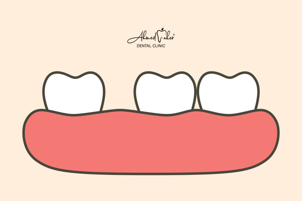 تكلفة علاج الفراغات بين الأسنان