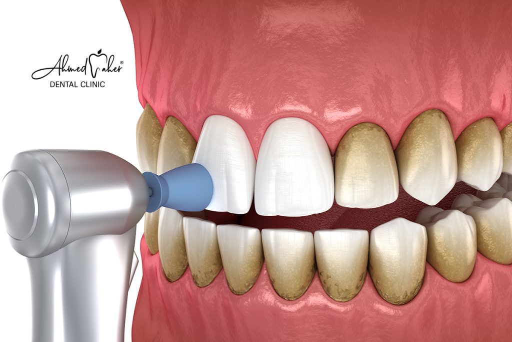 جلسة تنظيف وتلميع الاسنان