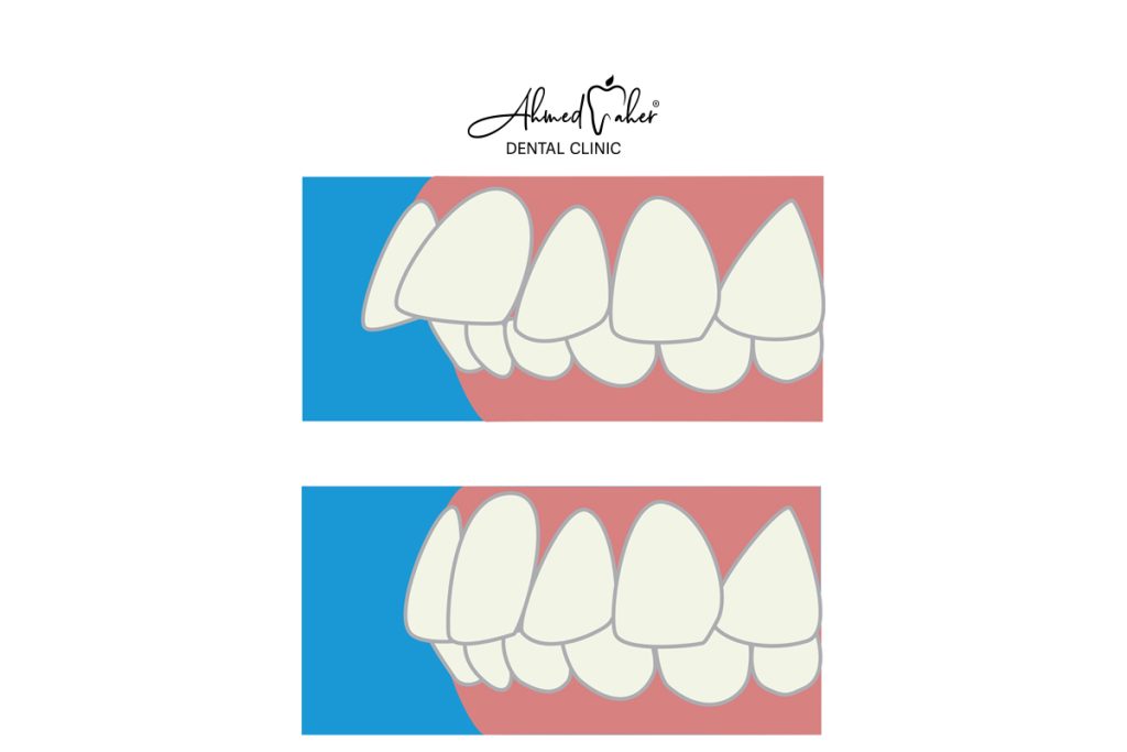 علاج بروز الاسنان بالتقويم​