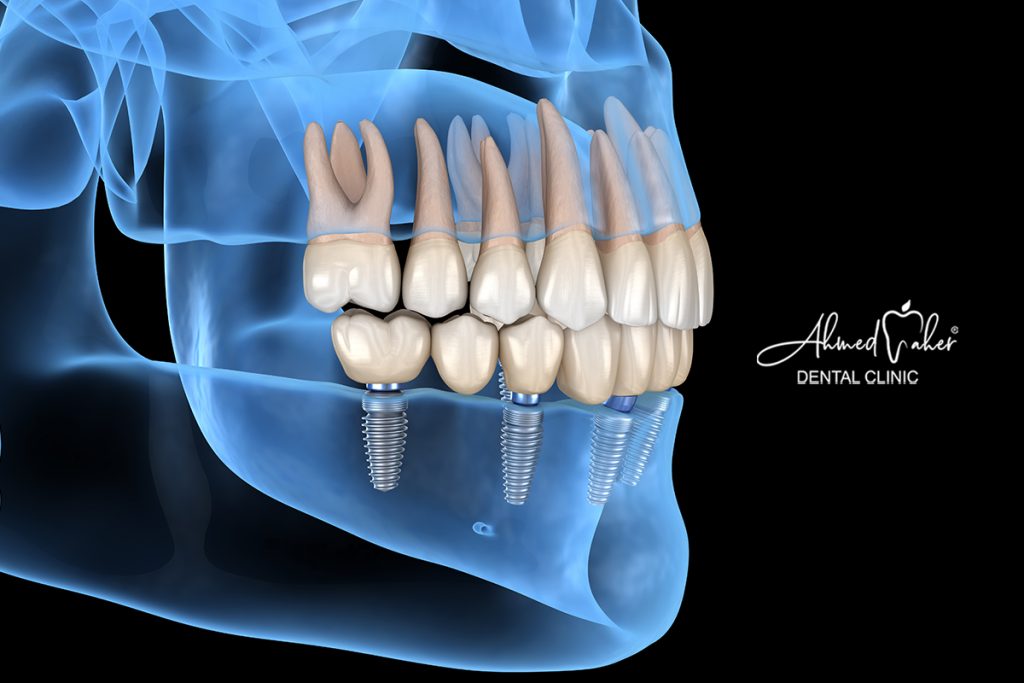 مدة عملية زراعة الاسنان