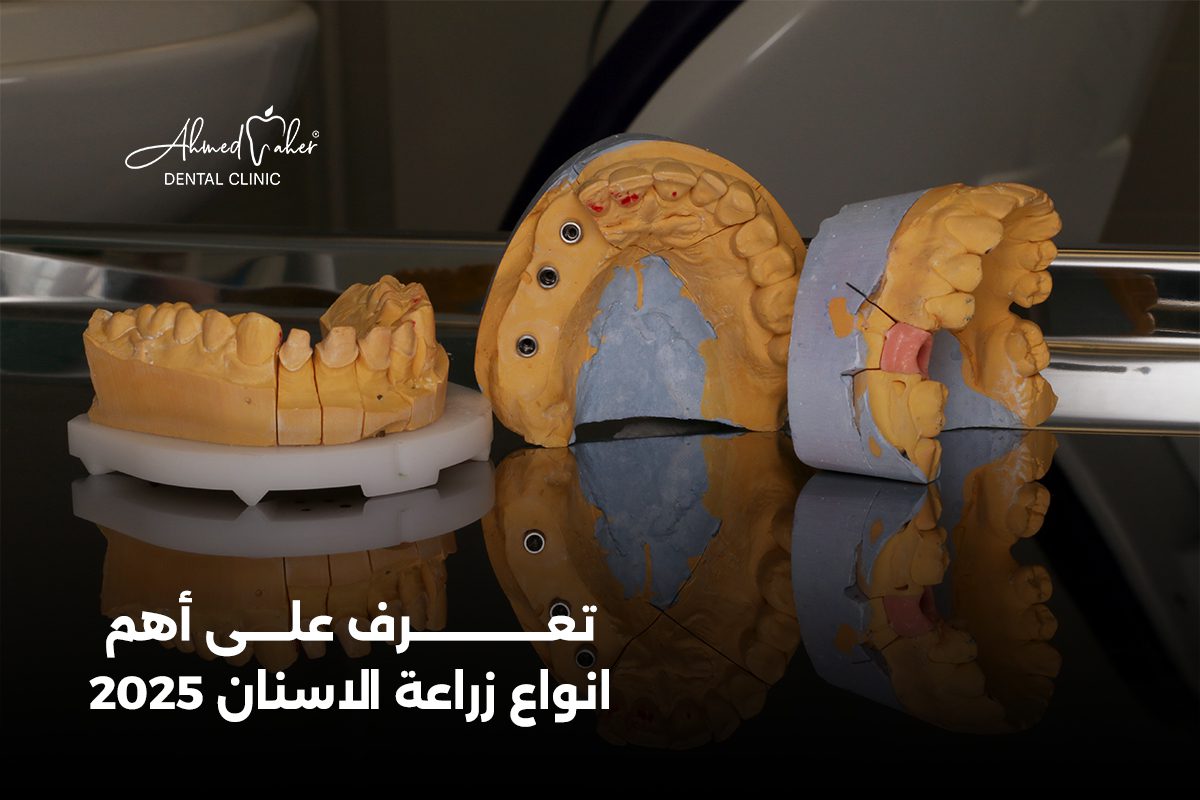 انواع زراعة الاسنان