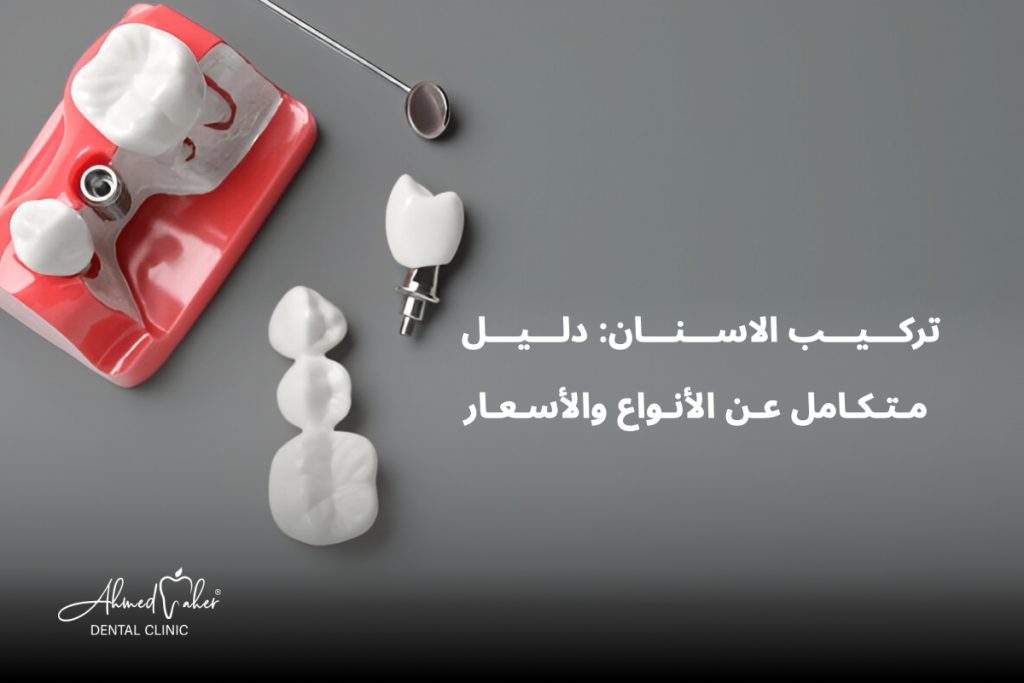 تركيب الاسنان