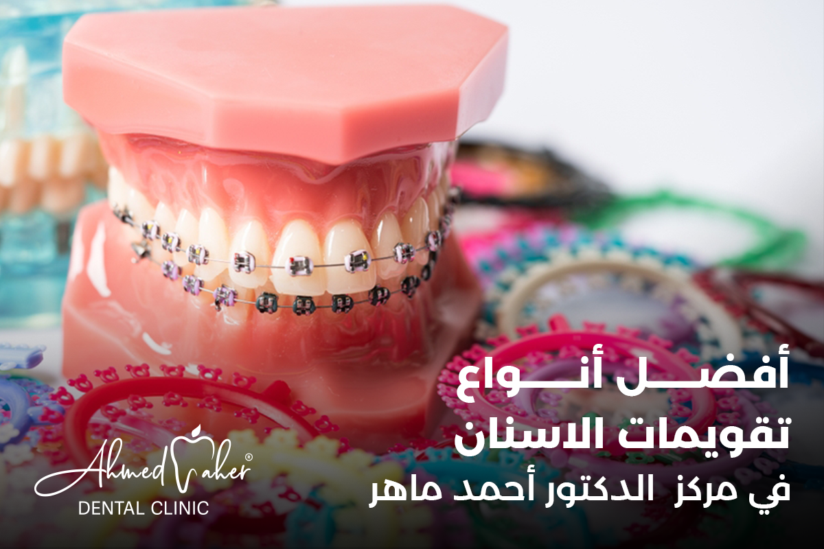افضل انواع تقويمات الاسنان