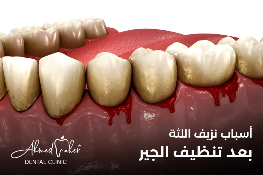 أسباب نزيف اللثة بعد تنظيف الجير