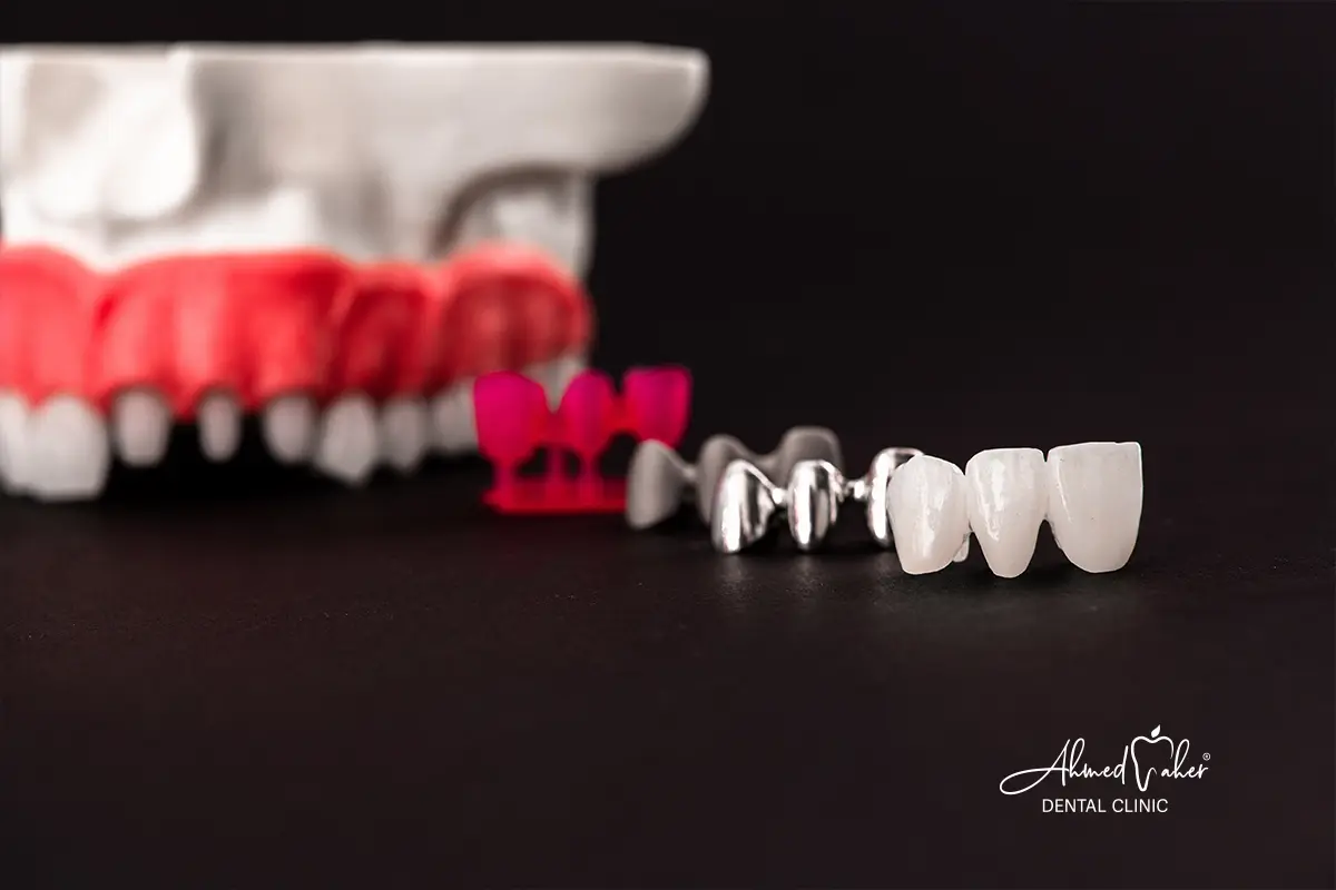 مراحل زراعة الأسنان