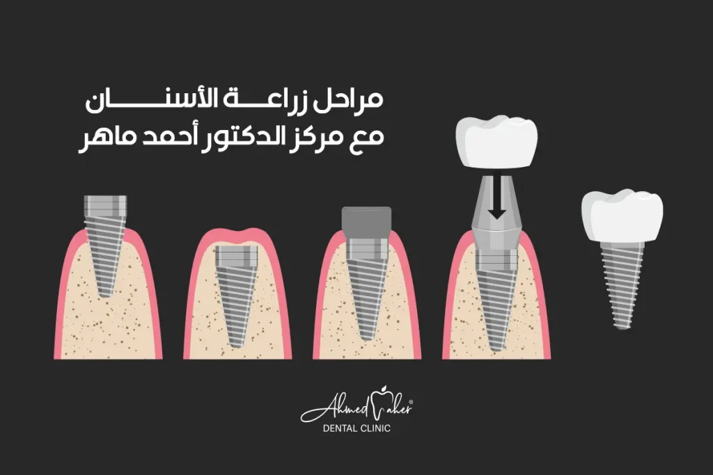 مراحل زراعة الأسنان من مركز الدكتور أحمد ماهر