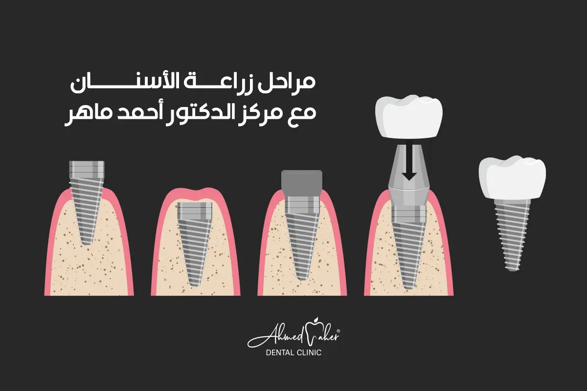 مراحل زراعة الأسنان من مركز الدكتور أحمد ماهر