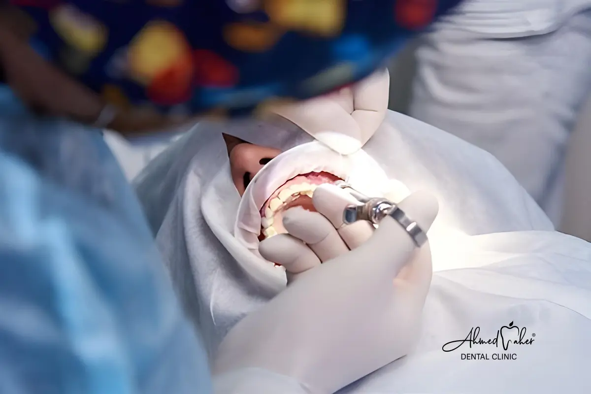 مراحل زراعة الأسنان