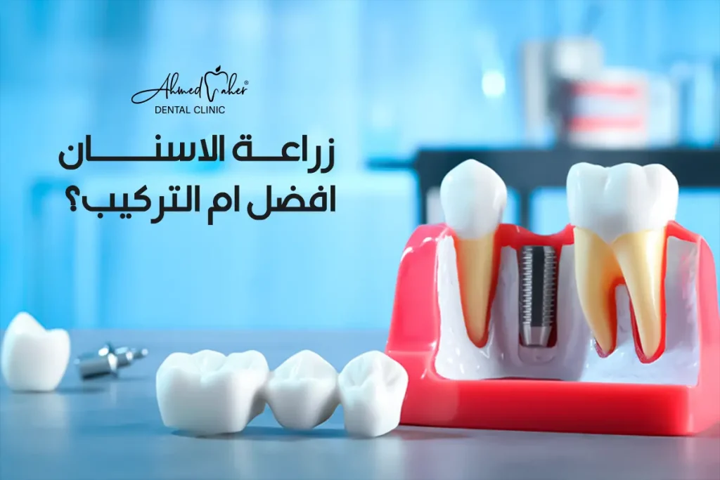 زراعة الاسنان افضل ام التركيب؟