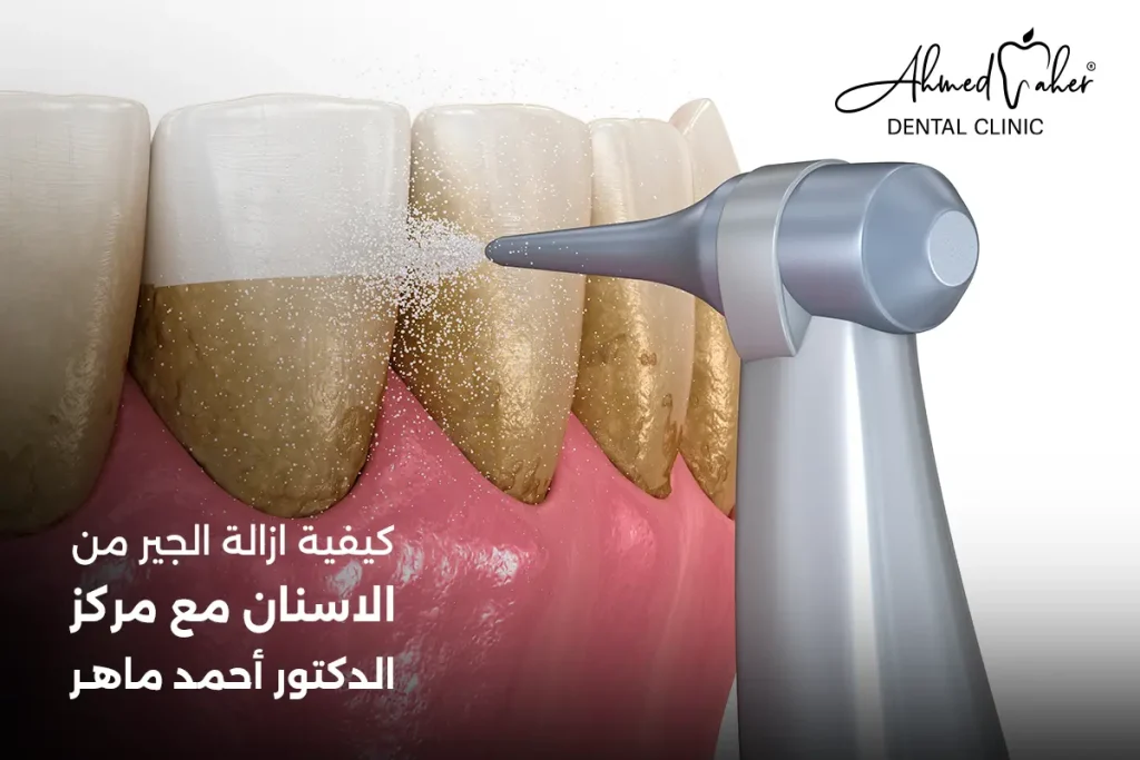 كيفية ازالة الجير من الاسنان (3)