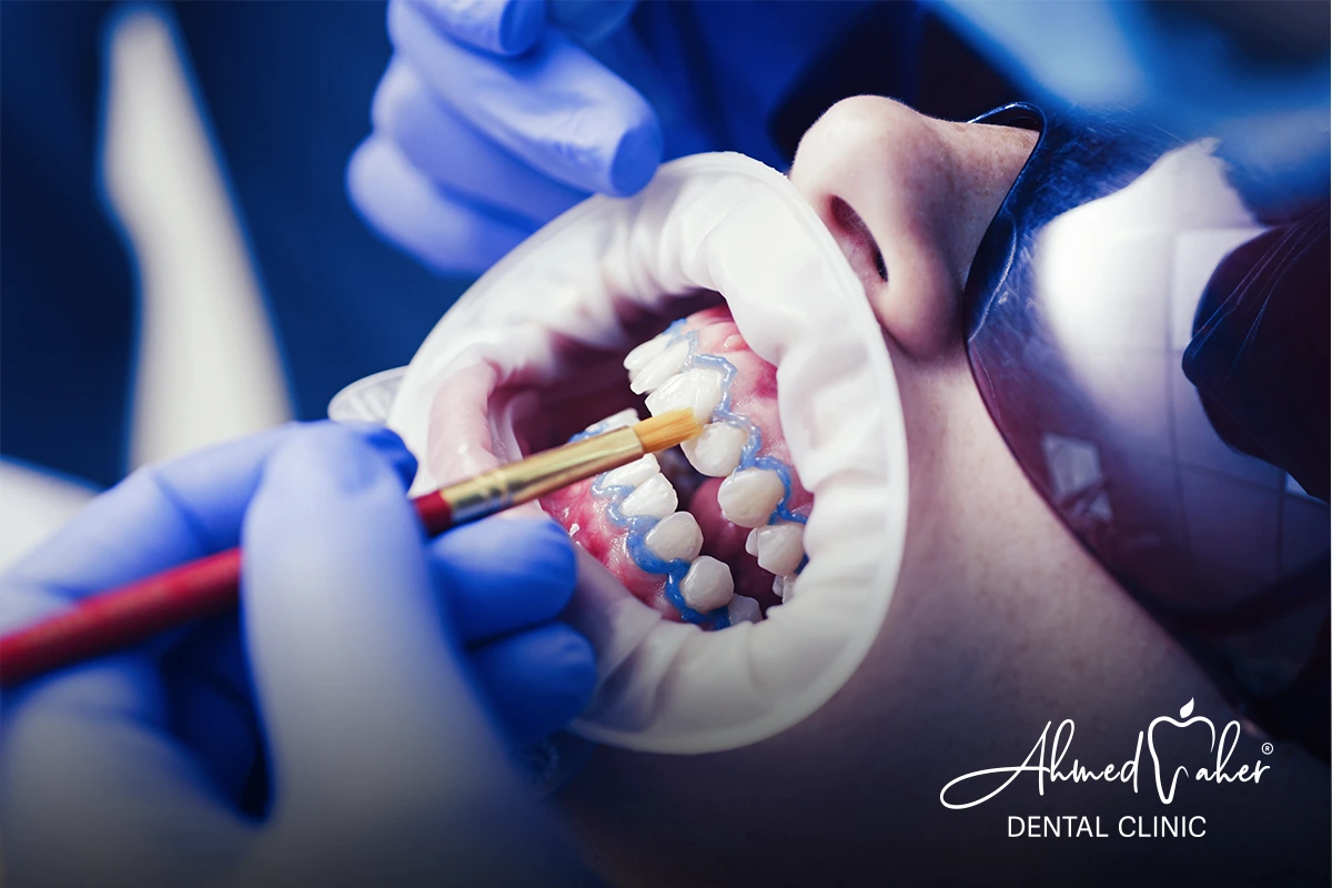 افضل ابتسامة هوليود في المنصورة بمركز الدكتور أحمد ماهر