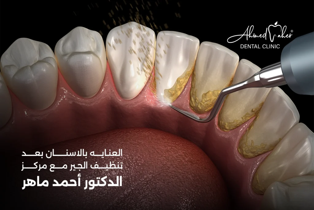 العنايه بالاسنان بعد تنظيف الجير