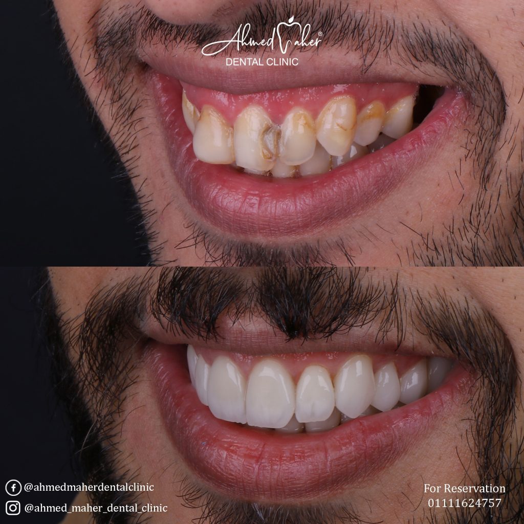 أفضل مركز تركيب فينير الاسنان في المنصورة