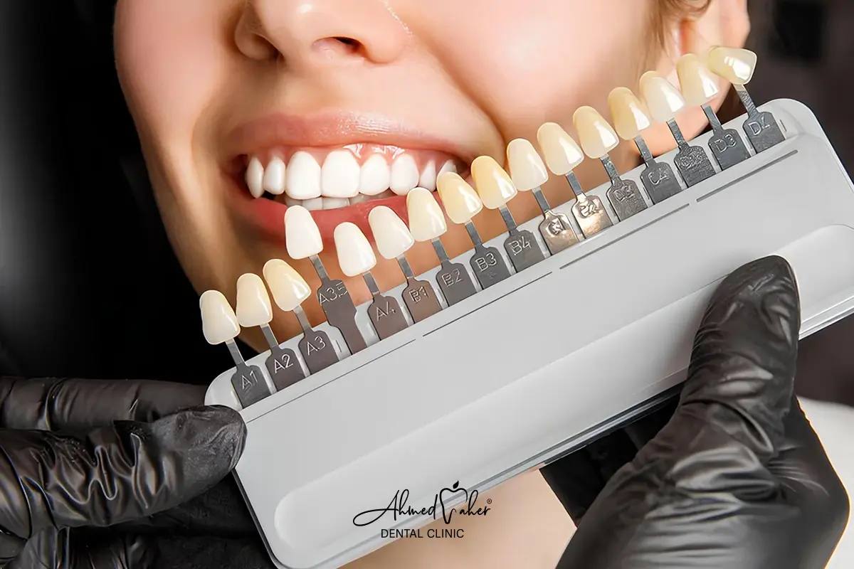 أفضل مركز تركيب فينير الاسنان في المنصورة