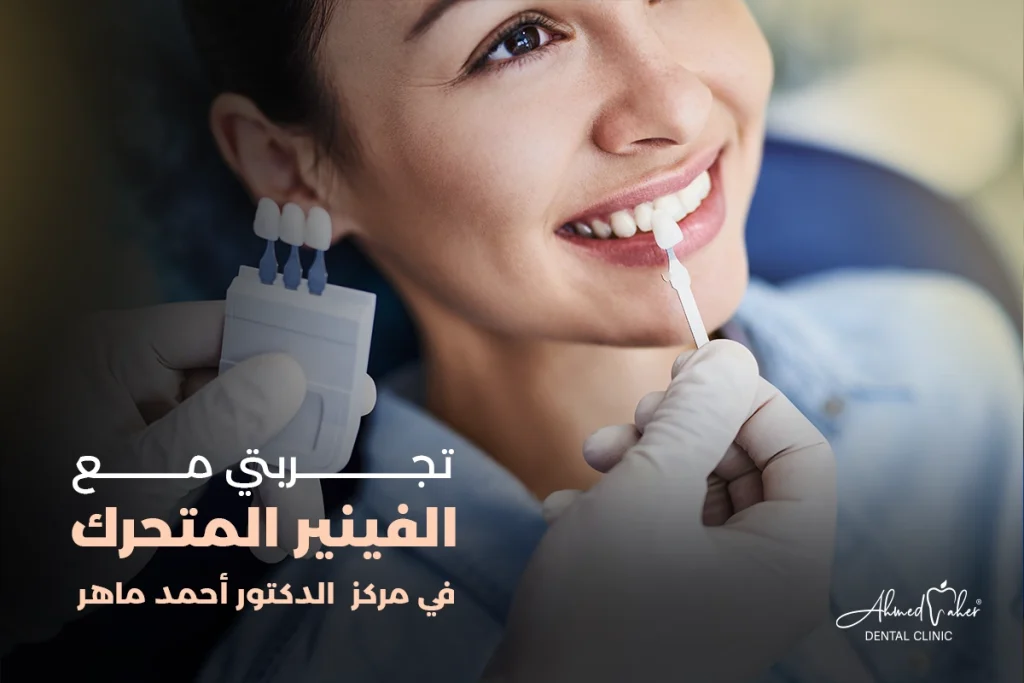 تجربتي مع الفينير المتحرك في مركز الدكتور أحمد ماهر