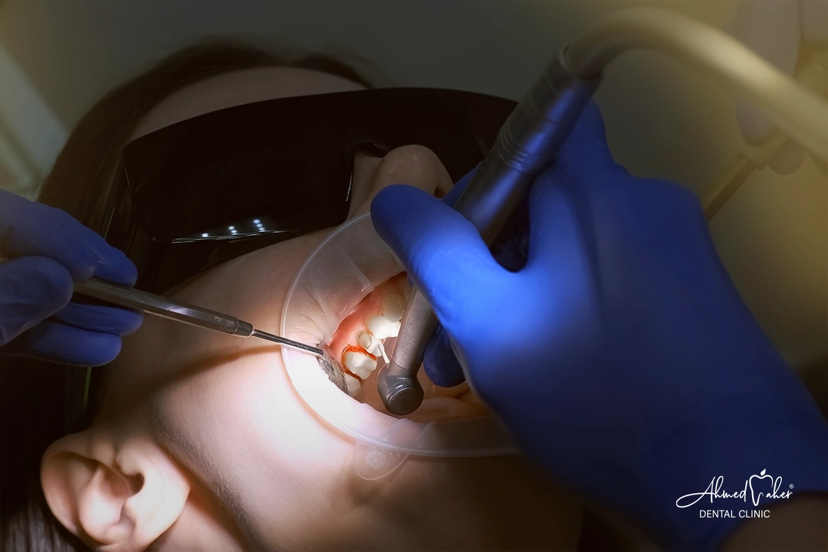 تجربتي مع الفينير المتحرك