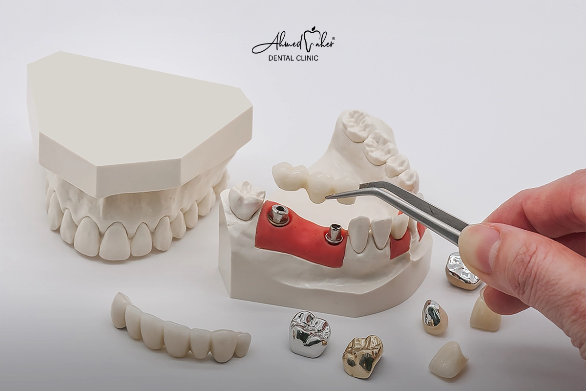 أفضل أنواع طربوش الأسنان